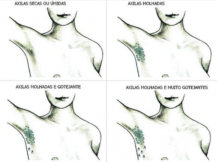 Eccessiva sudorazione ascelle
